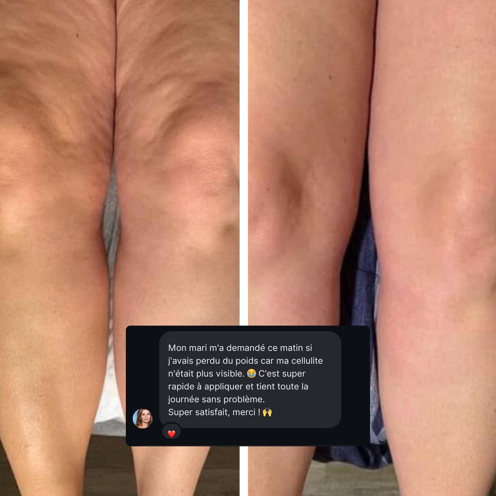 LIFTING TAPES | Sofort-Lift gegen Cellulite