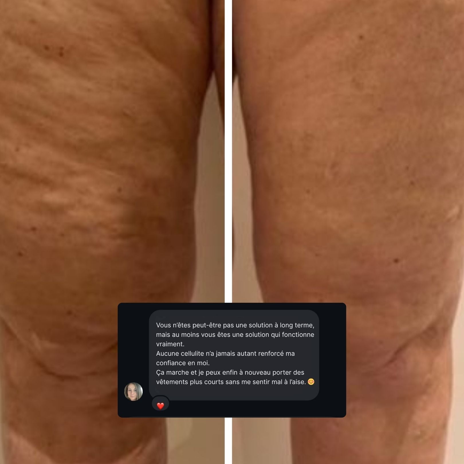 LIFTING TAPES | Sofort-Lift gegen Cellulite