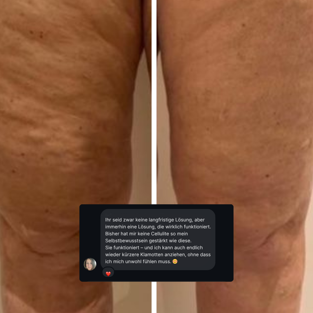 LIFTING TAPES | Sofort-Lift gegen Cellulite