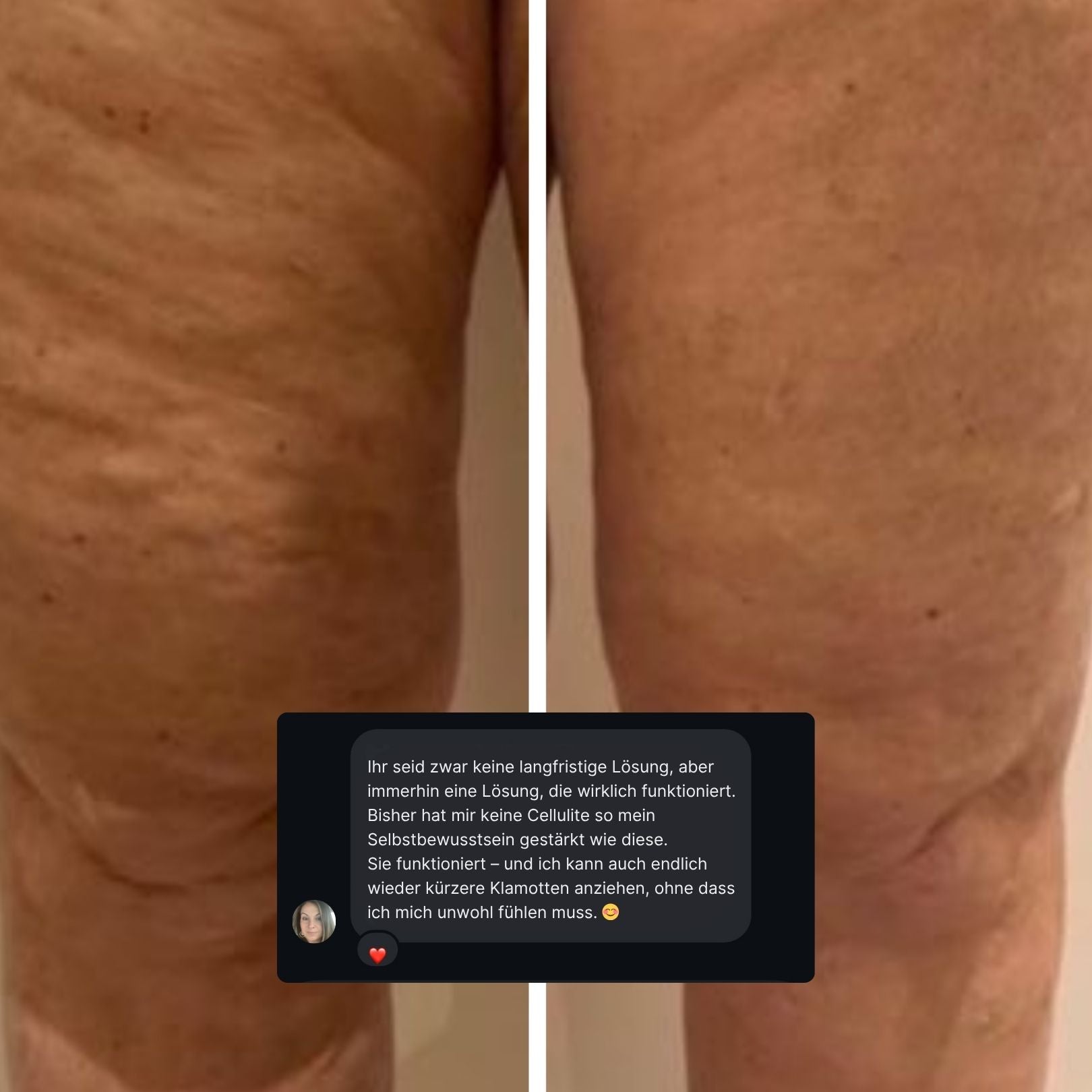 LIFTING TAPES | Sofort-Lift gegen Cellulite
